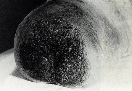 verrukoese hyperplasie.jpg - 27.86 Kb